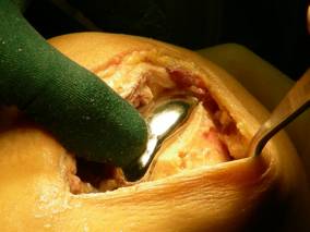 Immagine 7:  Impianto della protesi definitiva Quindi viene incementata la componente femorale.      